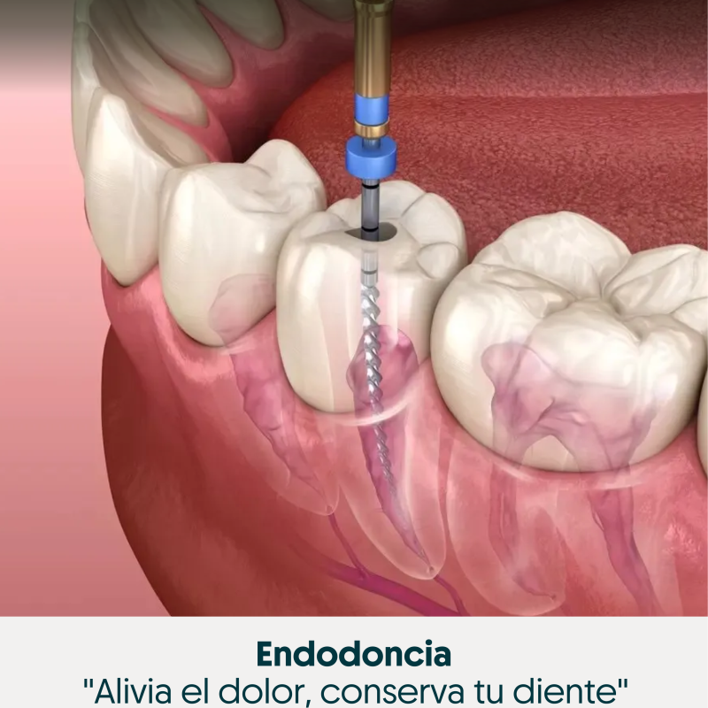  Endodoncia - Servicio dental especializado en Pasto
